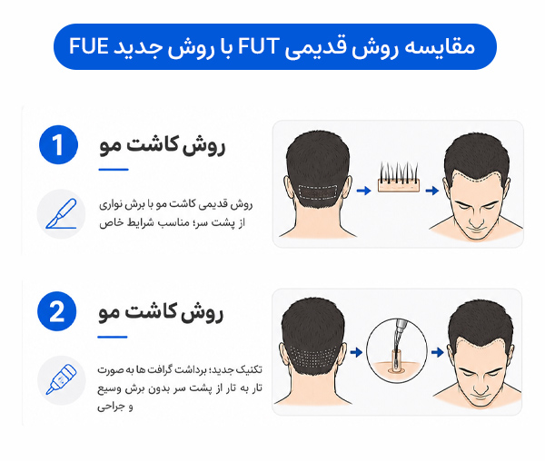 مقایسه انواع روش های کاشت مو