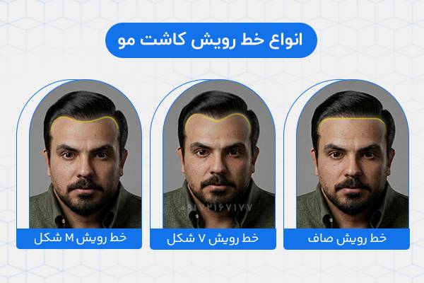 انواع طراحی خط رویش مو در کاشت مو