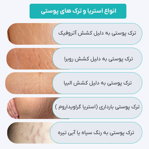 انواع استریا و ترک پوستی