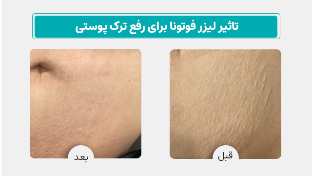 تاثیر لیزر فوتونا برای رفع ترک پوستی - عکس قبل و بعد