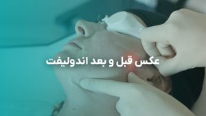 عکس قبل و بعد اندولیفت