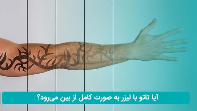 لیزر تاتو در شیراز 1 آیا تاتو با لیزر به صورت کامل از بین میرود؟