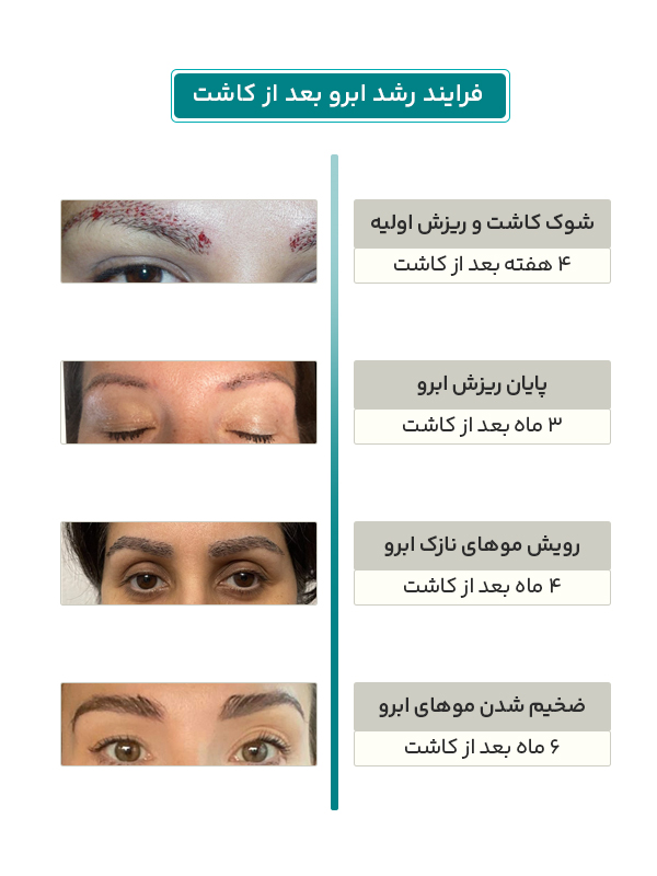 فرایند رشد ابرو بعد از کاشت