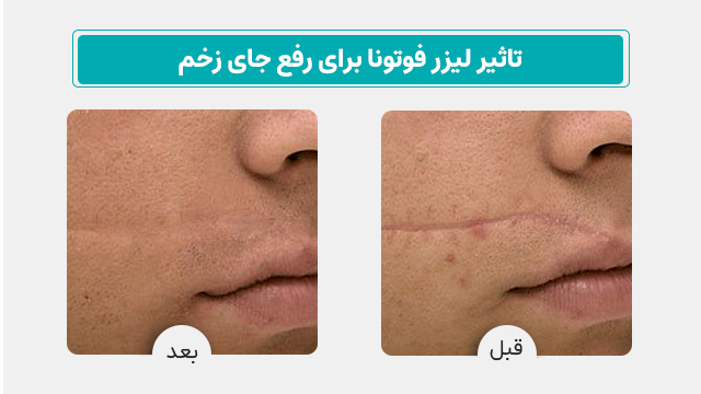 لیزر فوتونا برای رفع جای زخم