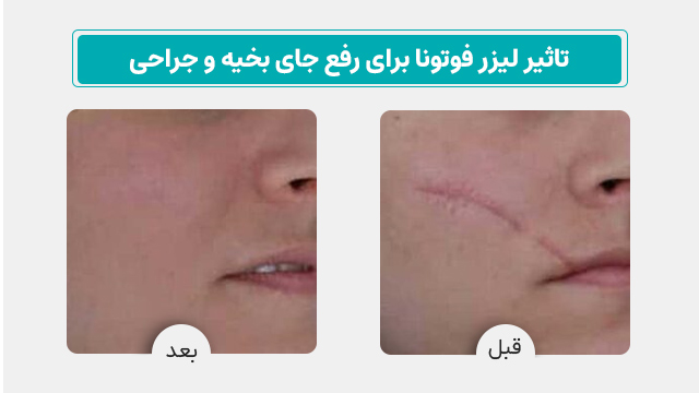لیزر فوتونا برای رفع جای بخیه و جراحی