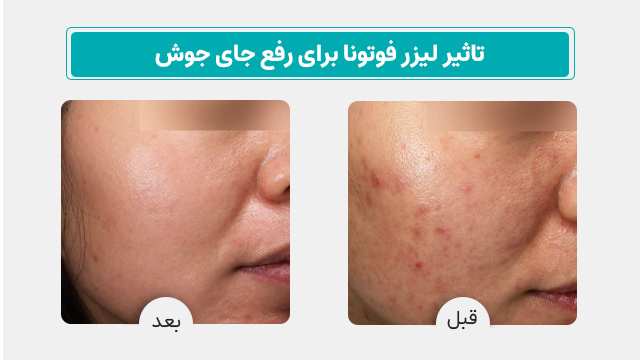 لیزر فوتونا برای رفع جای جوش و آکنه