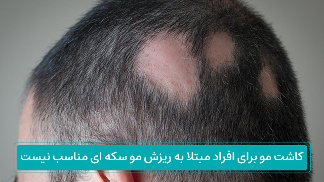 کاشت مو برای افراد مبتلا به ریزش مو سکه ای مناسب نیست. 