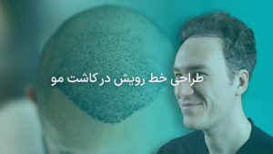 طراحی خط رویش مو در کاشت مو