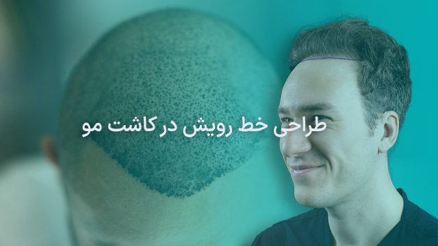 طراحی خط رویش مو در کاشت مو
