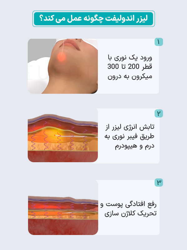عکس قبل و بعد اندولیفت 1 اندولیفت چگونه کار می کند؟