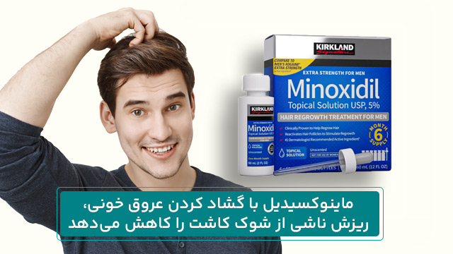 پیشگیری از ریزش مو بعد از کاشت 2 ماینوکسیدیل با گشاد کردن عروق خونی، ریزش ناشی از شوک کاشت را کاهش میدهد.