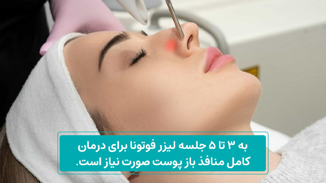 لیزر فوتونا برای منافذ باز پوست 2 تعداد جلسات لیزر فوتونا برای کاهش منافذ باز پوستی