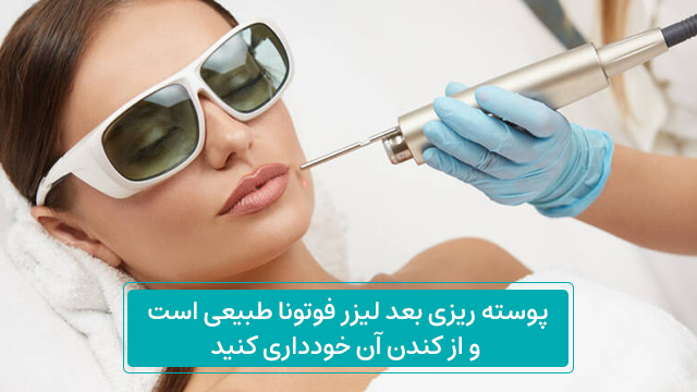 مراقبت های بعد از لیزر فوتونا 2 پوسته ریزی بعد لیزر فوتونا طبیعی است و از کندن آن خودداری کنید.