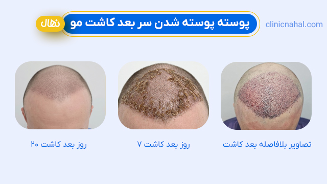 رفع پوسته پوسته شدن بعد از کاشت مو