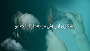 وبلاگ 18 پیشگیری از ریزش مو بعد از کاشت