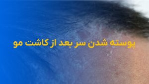 پوسته شدن سر بعد از کاشت مو