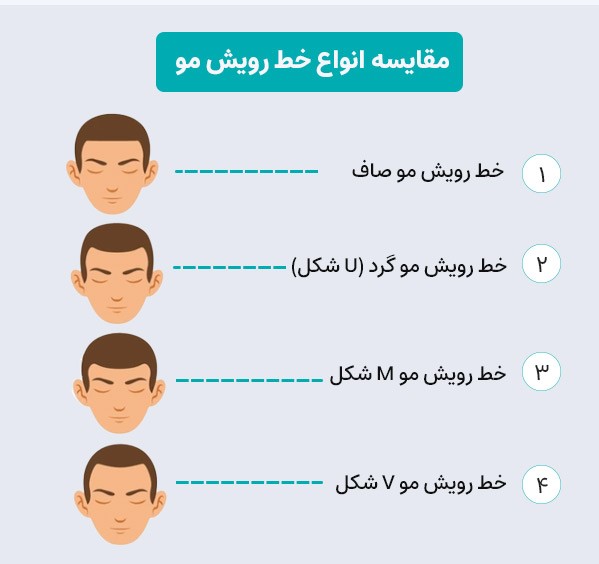 انواع رایج حط رویش مو در کاشت مو