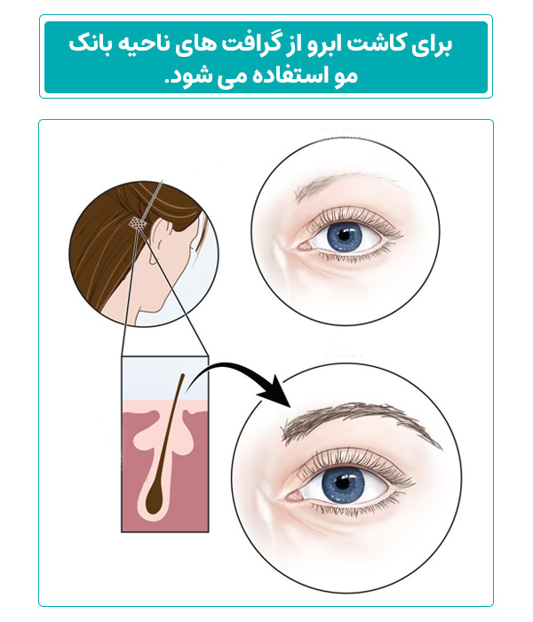 چند روز بعد از کاشت ابرو میریزد ؟ 1 برای کاشت ابرو از گرافت های ناحیه بانک مو استفاده می شود.