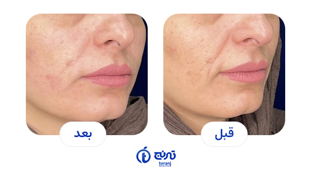 تصاویر قبل و بعد هایفو - کلینیک ترنج