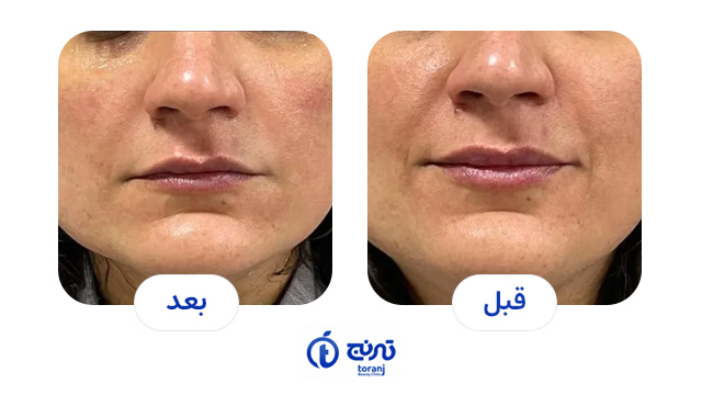 تصاویر قبل و بعد هایفو - کلینیک ترنج