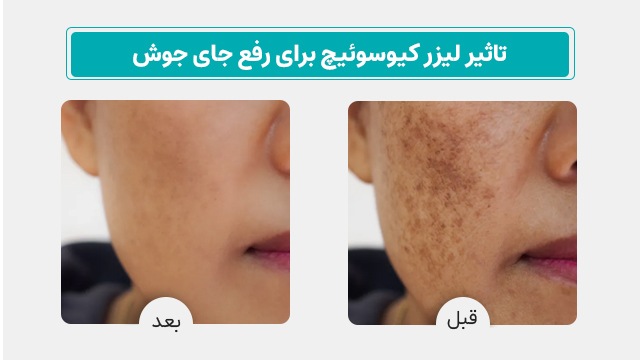 عکس لیزر کیوسوییچ برای جای جوش