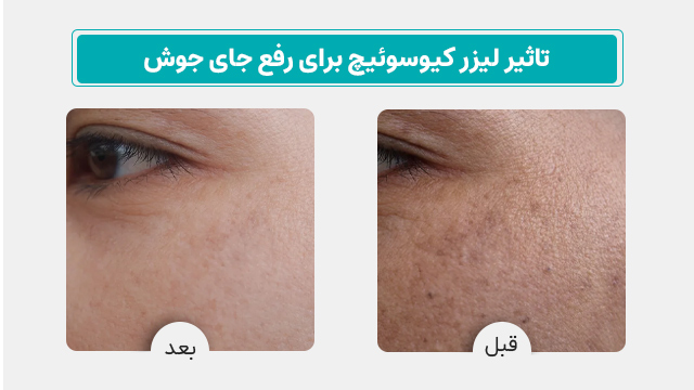 عکس لیزر کیوسوییچ برای جای جوش