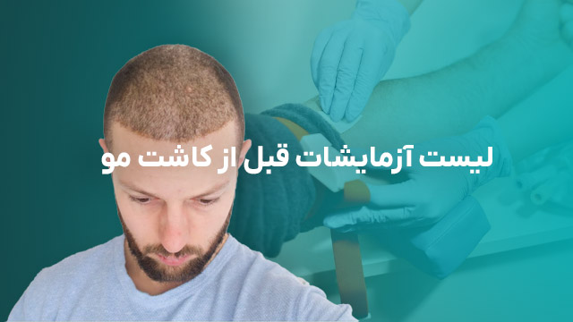 آزمایشات قبل از کاشت مو