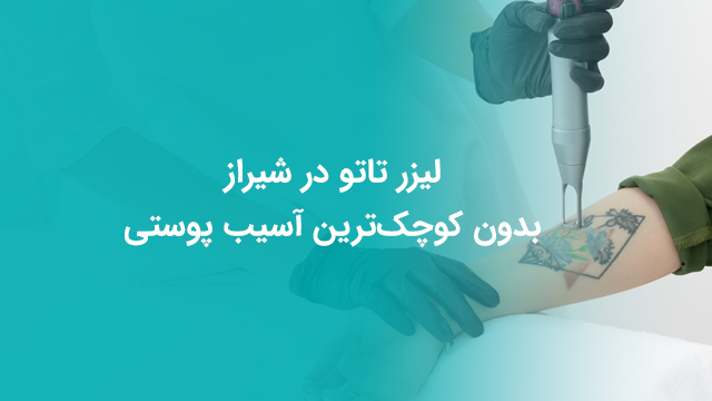 لیزر تاتو در شیراز
