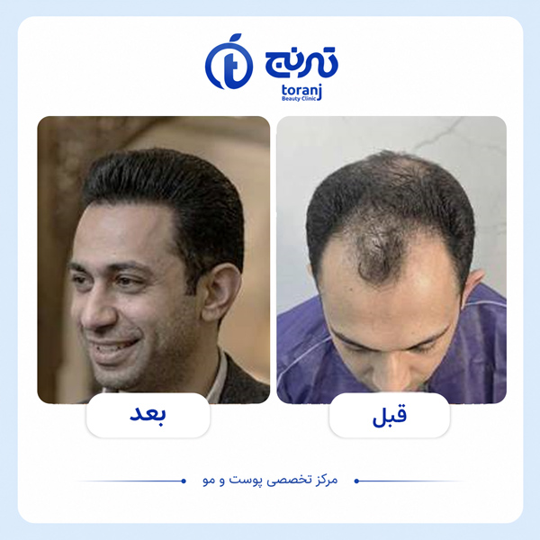 تصویر قبل و بعد کاشت مو در شیراز - کلینیک ترنج
