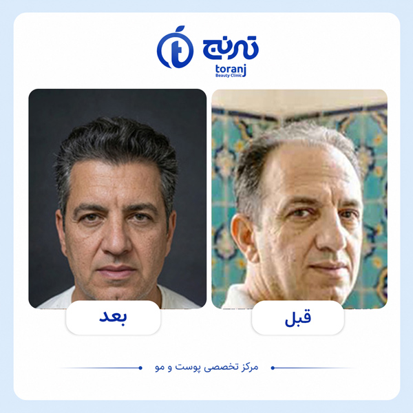 تصویر قبل و بعد کاشت مو در شیراز - کلینیک ترنج