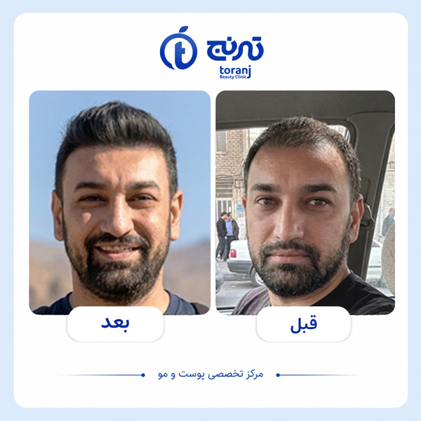 تصویر قبل و بعد کاشت مو در شیراز - کلینیک ترنج