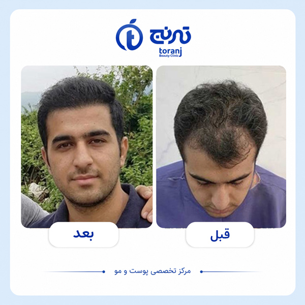 تصویر قبل و بعد کاشت مو در شیراز - کلینیک ترنج